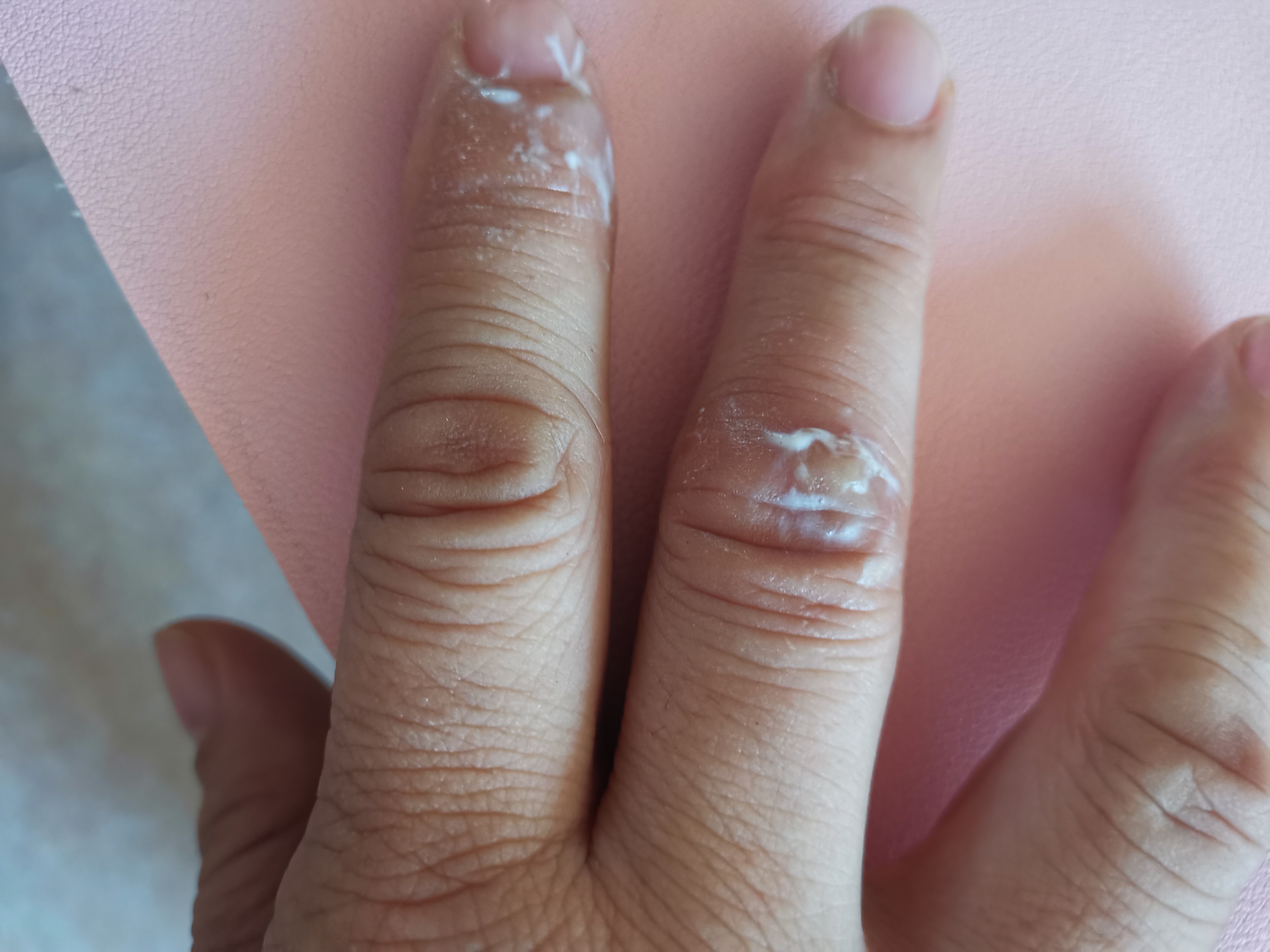 宝宝才三根手指就疼痛难忍